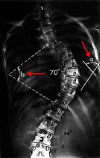 Scoliosis Scoliosis (12).gif